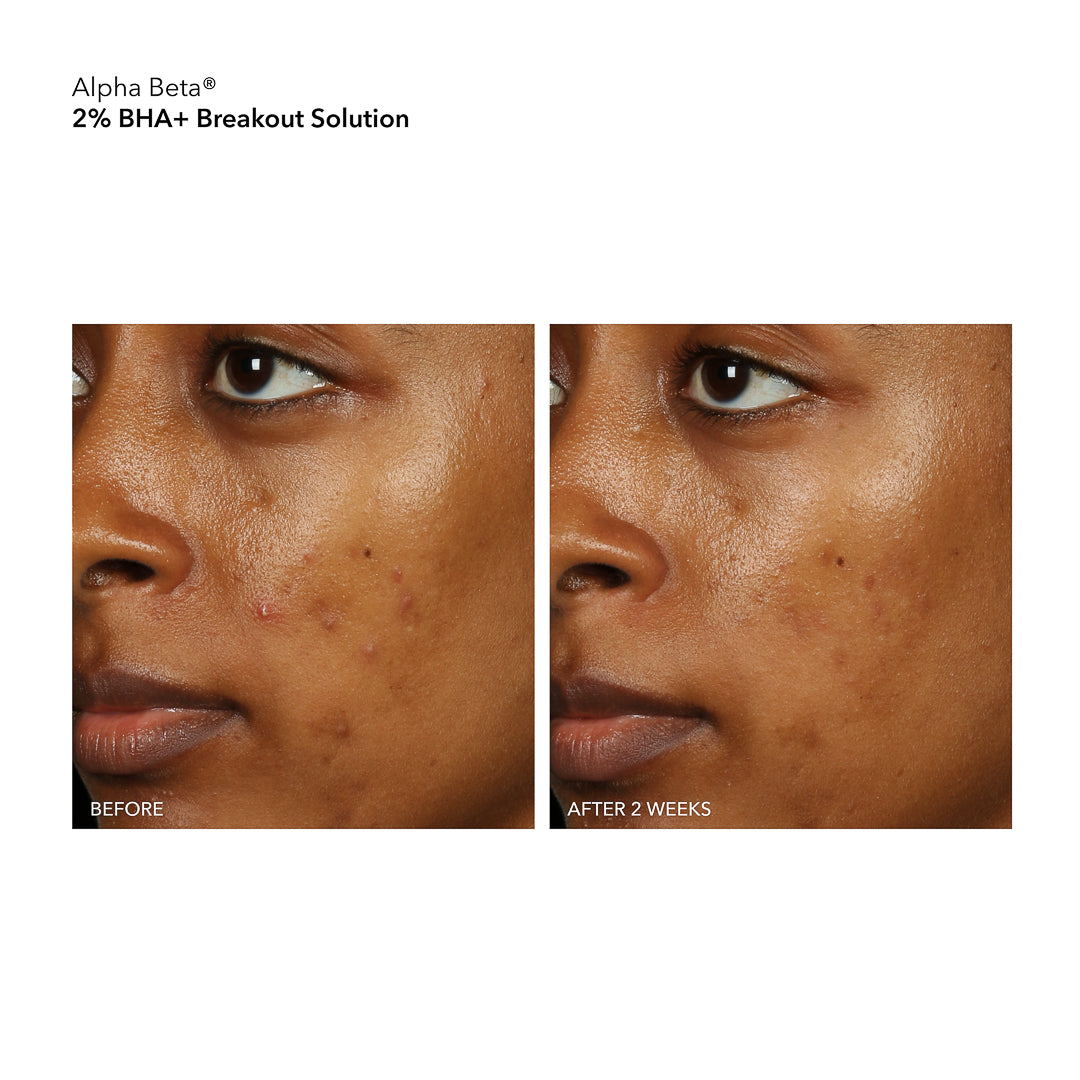 Dr. Dennis Gross Alpha Beta® 2% BHA+ Breakout Solution