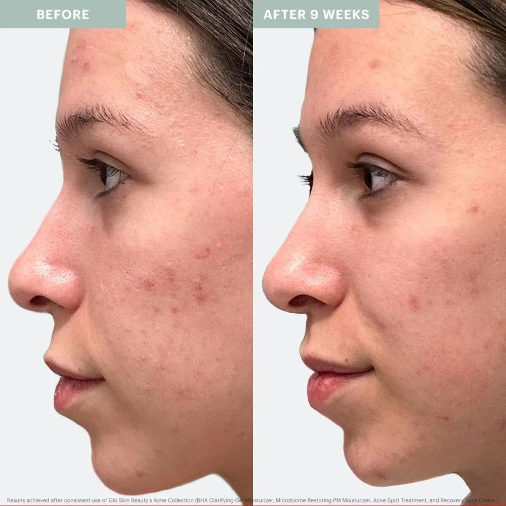 Glo Skin Beauty Acne Spot Treatment